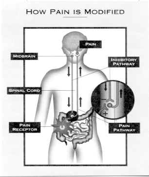 Centrally Mediated Abdominal Pain Syndrome (CAPS) Functional abdominal pain