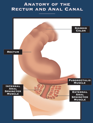 Anal Fistulas anal fistulas