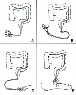 Placement of the motility catheter. A) The colonoscope is advanced beyond the curvature of the colon (splenic flexure) and a guidewire is passed through colonoscope. B) The colonoscope is withdrawn. C) The motility catheter is placed over the guidewire. D) The guidewire is then removed. colon Manometry image, colon, motility catheter, colonoscope