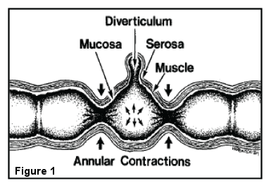 Diverticula, Diverticulosis, Diverticulitis: What’s the Difference? colonic diverticula